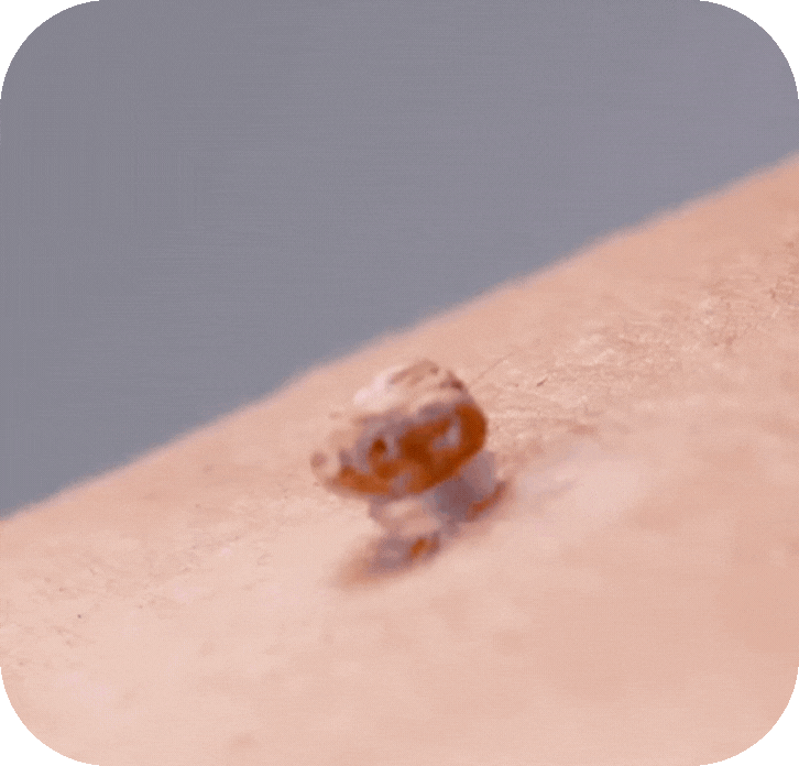 TagClear™ - Pain-free skin tag removal