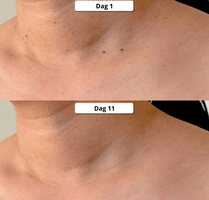 TagClear™ - Pain-free skin tag removal